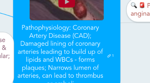 Mind Map: Pathophysiology: Coronary Artery Disease (CAD); Damaged lining of coronary arteries leading to build up of lipids and WBCs - forms plaques; Narrows lumen of arteries, can lead to thrombus or emboli